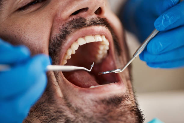 Best Emergency Tooth Extraction in Wmette, IL